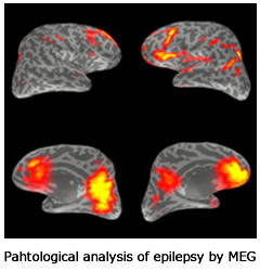 Pahtological analysis of epilepsy by MEG